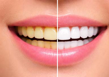 Professional Teeth Whitening